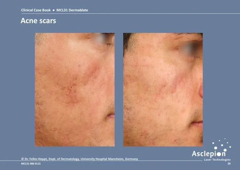 Before and after acne scar treatment with Dermablate laser - dramatic improvement in skin texture