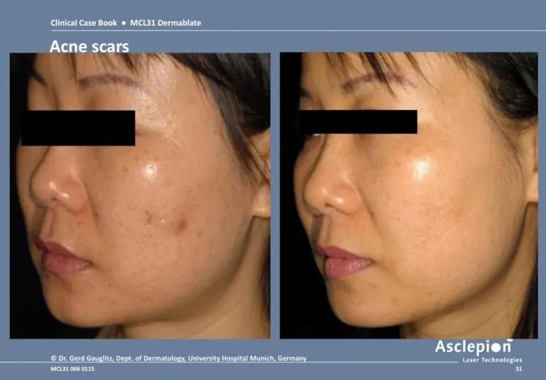 Complete Guide to Acne Scar Treatment in Malaysia: Options, Costs & Results - Medicyto Clinic blog article