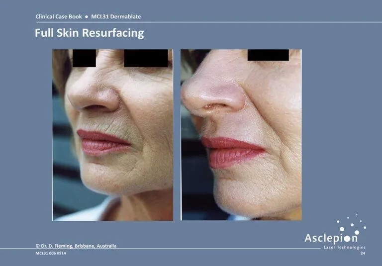 Full face skin resurfacing with Dermablate - refined texture and reduced wrinkles