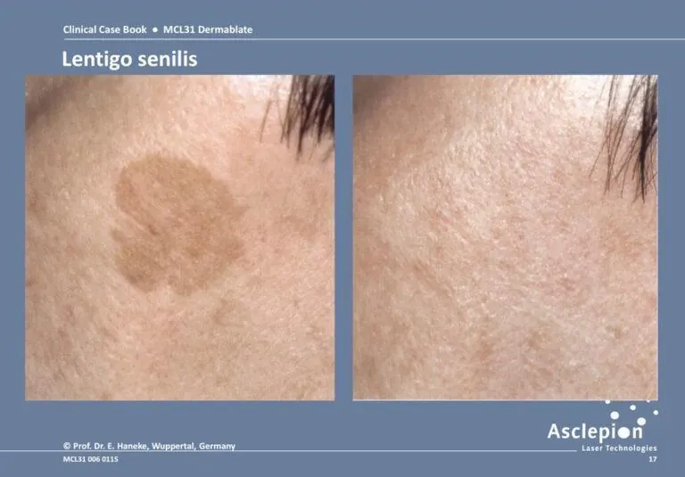 Age spots and lentigines removal with Dermablate laser - clear, even skin tone